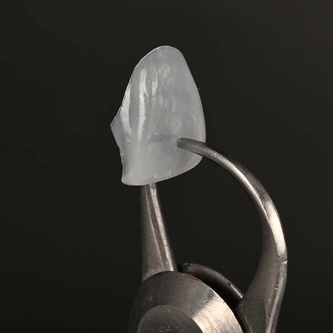 Close-up of a dental veneer restoration